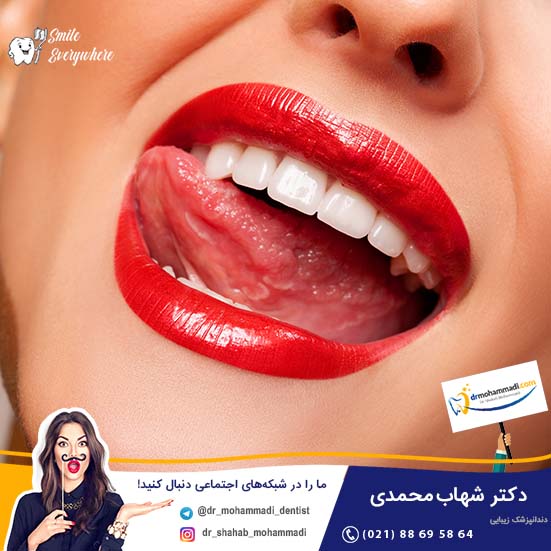 آیا بلیچینگ قبل از کامپوزیت دندان لازم است؟ - کلینیک دندانپزشکی دکتر شهاب محمدی